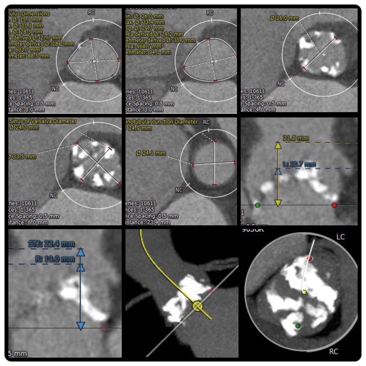 Luis Arboine 🫀 (@luis_arboine) on Twitter photo Severe AS wt LV/RV failure EF <23%. Turn down Surgery. BAV Type 0 wt small STJ. #TAVR evaluation Thoughts? EV34/S26/29? Tks
<a href="/ozkr_millan/">Oscar Millan</a> <a href="/GilbertTangMD/">Dr. Gilbert Tang</a> <a href="/Almanfi_Cardio/">Abdelkader Almanfi, MD, FACC, FSCAI</a> <a href="/msztejfman/">Matias Sztejfman</a> <a href="/KHERA_MD/">Sahil Khera</a> <a href="/SachinGoelMD/">Sachin Goel</a> <a href="/ShariqShamimMD/">Dr Shariq Shamim</a> <a href="/LucvdBerg73/">Luc van den Berg</a> <a href="/PedroMDMSc/">Pedro Villablanca MD, MSc, FACC, FSCAI</a> <a href="/cardiowiis/">Matt Wiisanen, MD, FSCAI, FACC</a> <a href="/TribelessSapien/">Adnan Nadir</a> #TAVI Severe AS wt LV/RV failure EF <23%. Turn down Surgery. BAV Type 0 wt small STJ. #TAVR evaluation Thoughts? EV34/S26/29? Tks
<a href="/ozkr_millan/">Oscar Millan</a> <a href="/GilbertTangMD/">Dr. Gilbert Tang</a> <a href="/Almanfi_Cardio/">Abdelkader Almanfi, MD, FACC, FSCAI</a> <a href="/msztejfman/">Matias Sztejfman</a> <a href="/KHERA_MD/">Sahil Khera</a> <a href="/SachinGoelMD/">Sachin Goel</a> <a href="/ShariqShamimMD/">Dr Shariq Shamim</a> <a href="/LucvdBerg73/">Luc van den Berg</a> <a href="/PedroMDMSc/">Pedro Villablanca MD, MSc, FACC, FSCAI</a> <a href="/cardiowiis/">Matt Wiisanen, MD, FSCAI, FACC</a> <a href="/TribelessSapien/">Adnan Nadir</a> #TAVI