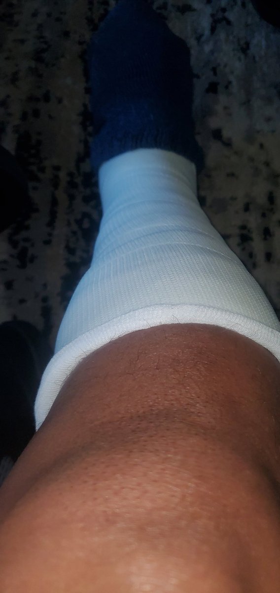 Skuff302's tweet photo. @DrJ_knows15 Get well Dr. J, I'm on this end of my Achilles recovery... February 25th was my surgery date. https://t.co/MGdfD3tO5A