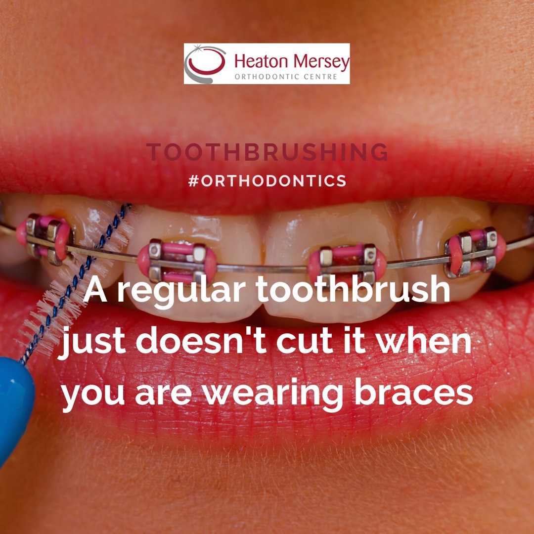 An interdental toothbrush allows you to clean behind the braces and remove food residue 👌
Send us a message if you have any questions.
#Interdentalbrushes #AdultOrthodontics