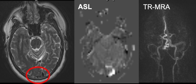 KambizNael's tweet photo. Hx: Pulsatile tinnitus. if you don't make the diagnosis on T2, #ASL will! #AVDF #Neurorad #Radres #NeuroIR #Neurosurgery #NeuroTwitter #Neurology  @UCLANeurorads   @RadiologyUcla https://t.co/Q1J11inNUS