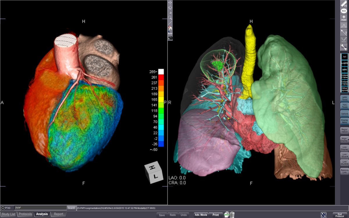 ziosoft's tweet photo. @thoracicrad Thank you STR for organizing a highly successful imaging conference.  Amazing hospitality!  Ziosoft is looking forward to be a part of it next year. #STR2022 #radiology #Cardiovascular #CardioTwitter  #cardio #surgery https://t.co/ruWmvph4Dd