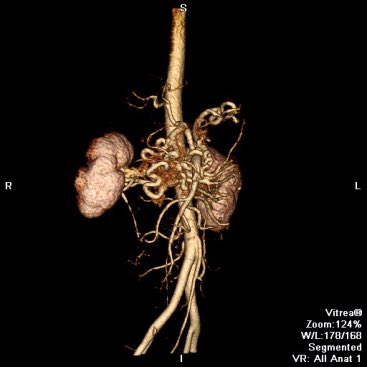 Society for MRA (@smrangio) on Twitter photo What is the best way to ensure correct timing of contrast-enhanced MRA for visualising the abdominal arterial vasculature? This reconstructed example from @GilesRoditi and Peter Douglas was featured in SMRA's MR Angiography series. #oneprettypictureSMRA <a href="/SMRAngio/">Society for MRA</a> What is the best way to ensure correct timing of contrast-enhanced MRA for visualising the abdominal arterial vasculature? This reconstructed example from @GilesRoditi and Peter Douglas was featured in SMRA's MR Angiography series. #oneprettypictureSMRA <a href="/SMRAngio/">Society for MRA</a>