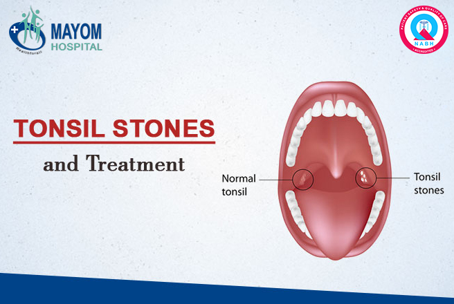 MayomHos_24X7's tweet photo. Tonsil Stones and Treatment
What is tonsil?
#Tonsil is a gland. There are two tonsils in our body. It is on both sides in the back part of the throat. Read More:- https://t.co/NKMYWYcbDE
#tonsilstones #treatment #entspecialist #drmanishprakash #healthcare #MayomHospital https://t.co/Hu70I3G1B0