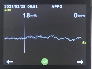 Martinfox2000's tweet photo. Ok @Leannejane1975 .. so @LegsMatter @NatWoundStrat @footindiabetes @RoyColPod … @BritishLymph @WeDistrictNurse &amp; others, can we all adopt toe systolic pressures &amp; #WIfI as a common nursing &amp; podiatry approach, to the assessment &amp; triage of all DFUs.. in 🇬🇧 ? 🦵🫀#livesandlimbs https://t.co/l4c9EgIce6