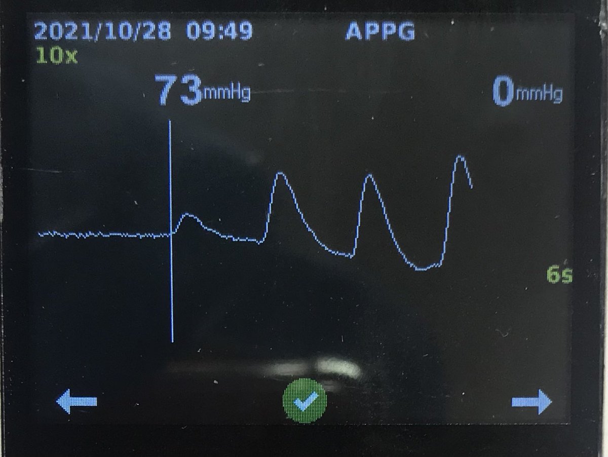 Martinfox2000's tweet photo. Ok @Leannejane1975 .. so @LegsMatter @NatWoundStrat @footindiabetes @RoyColPod … @BritishLymph @WeDistrictNurse &amp; others, can we all adopt toe systolic pressures &amp; #WIfI as a common nursing &amp; podiatry approach, to the assessment &amp; triage of all DFUs.. in 🇬🇧 ? 🦵🫀#livesandlimbs https://t.co/l4c9EgIce6