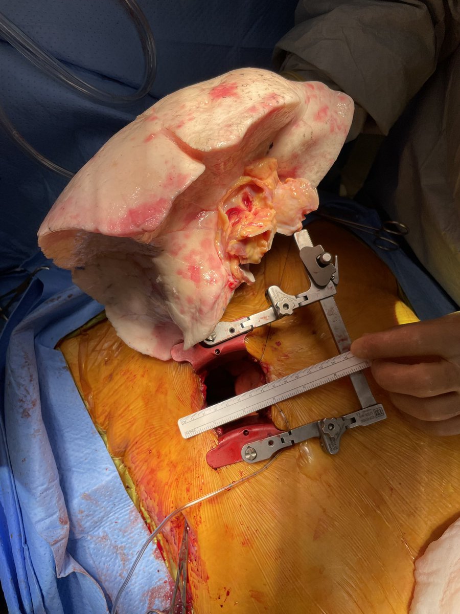 LA Lung Transplant tweet media