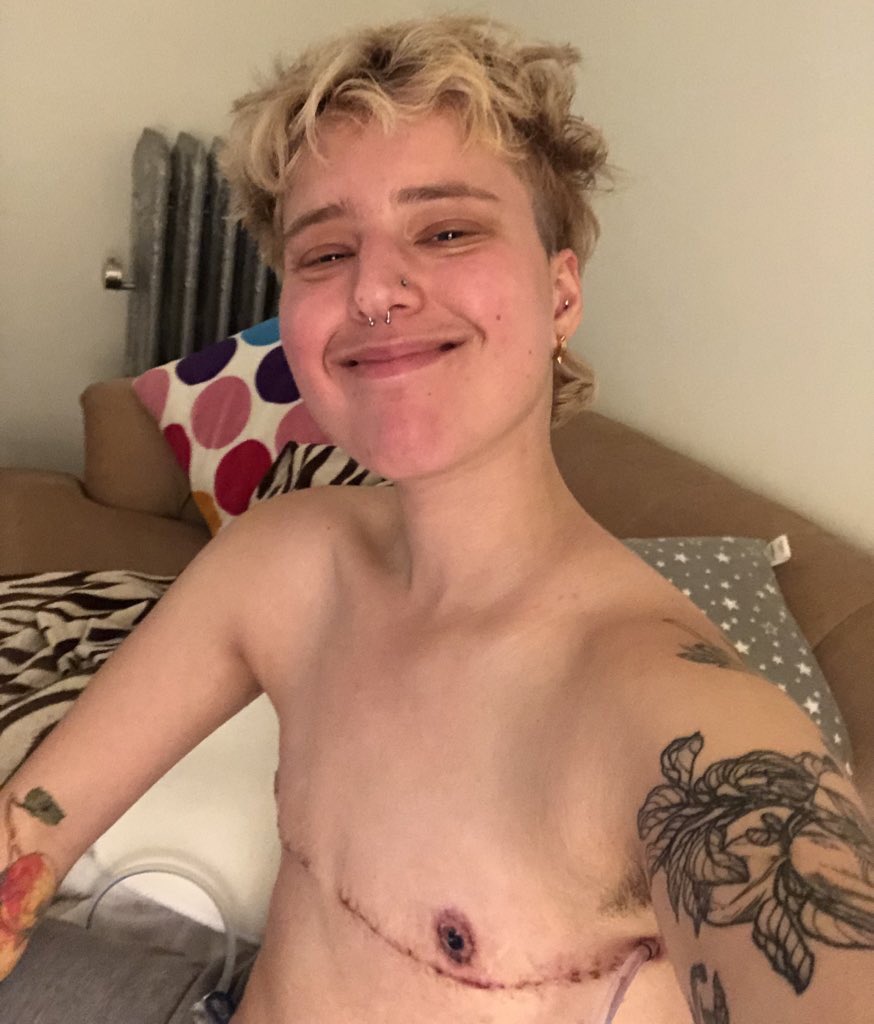 bonusholebarbie's tweet photo. Bonus pics bc despite my financial situation, I couldn’t be more thrilled with my results ❤️ Dr. B-L & her team are genuine angels #topsurgery #doubleincision #ftm #nyulangone #nonbinary #transmasc #drbluebondlangner #gendereuphoria #transjoy #TransIsBeautiful #queer #transmen https://t.co/FgkRBsRGyC