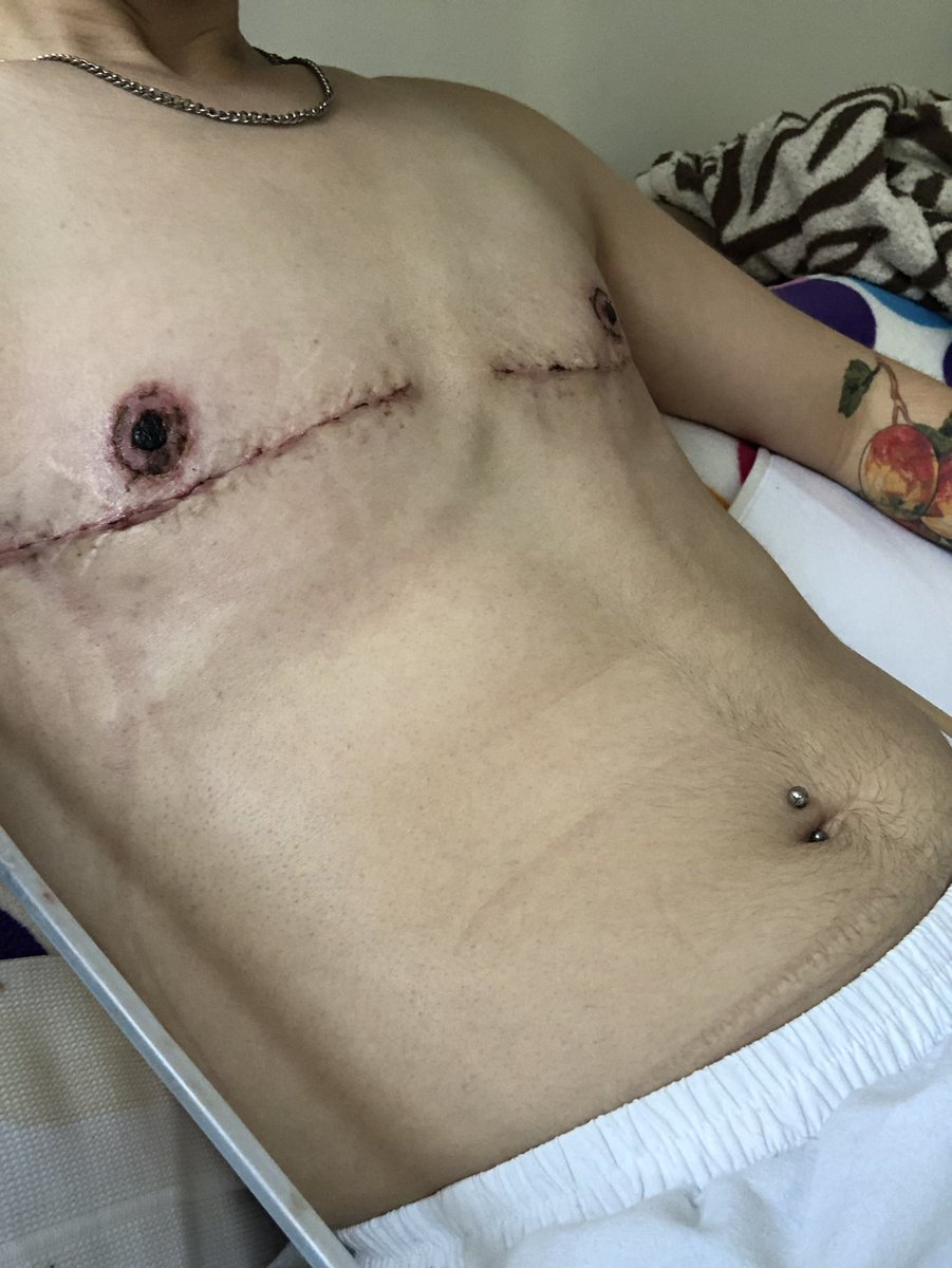 bonusholebarbie's tweet photo. Bonus pics bc despite my financial situation, I couldn’t be more thrilled with my results ❤️ Dr. B-L & her team are genuine angels #topsurgery #doubleincision #ftm #nyulangone #nonbinary #transmasc #drbluebondlangner #gendereuphoria #transjoy #TransIsBeautiful #queer #transmen https://t.co/FgkRBsRGyC