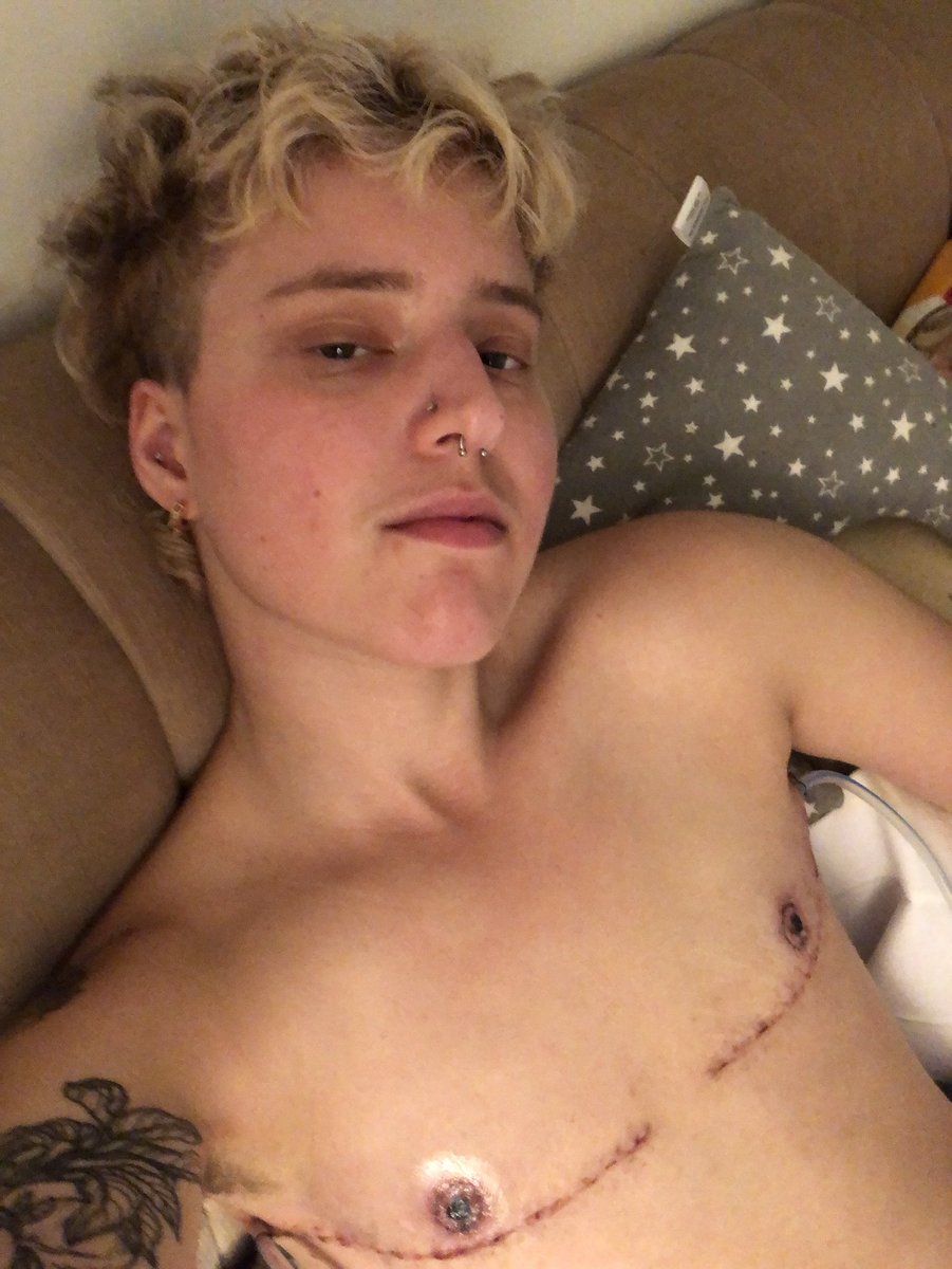 bonusholebarbie's tweet photo. Bonus pics bc despite my financial situation, I couldn’t be more thrilled with my results ❤️ Dr. B-L & her team are genuine angels #topsurgery #doubleincision #ftm #nyulangone #nonbinary #transmasc #drbluebondlangner #gendereuphoria #transjoy #TransIsBeautiful #queer #transmen https://t.co/FgkRBsRGyC