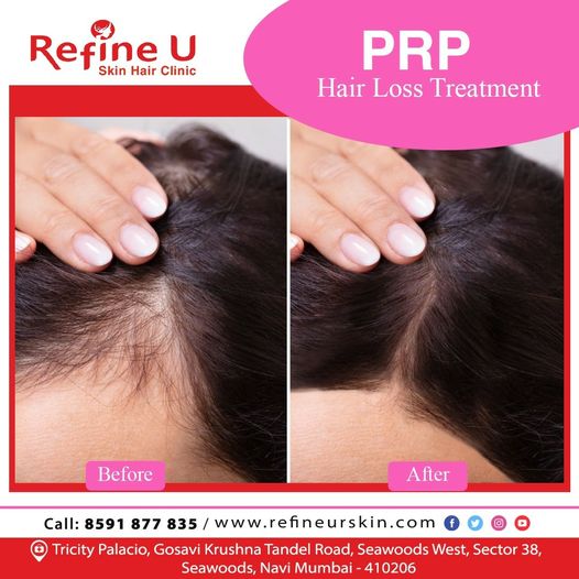 refine_u's tweet photo. Consult at Refine-U Seawood Navi Mumbai for hair loss treatment (PRP).
.
.
 #PRP #hairlosstreatment #haircare #hairlosssolution #hairlossspecialist #hairtransplant #refineu #DrRashami #seawood #NaviMumbai https://t.co/y9xl6gkfJ1