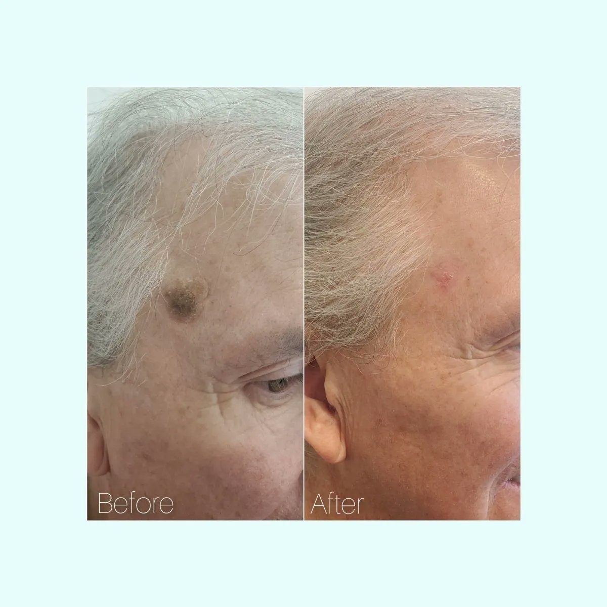DrLian_Beauty's tweet photo. Plexr is my "Magic Eraser". It can address seborrheic keratosis <Seb k's> (seb-o-REE-ik ker-uh-TOE-sis).
Seb k's are noncancerous skin growths that can develop throughout the body with age.  Traditionally they are treated with liquid nitrogen, but Plexr is the way! 
#plexrplus https://t.co/Rq7VJcnBbo