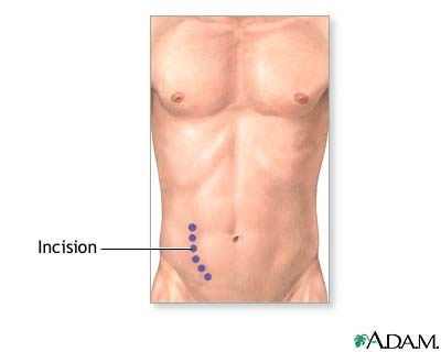 31M presents for a routine health assessment. You notice a scar in the RLQ. What would you be thinking?

Open this thread and I'll share my approach.

<a href="/MedTweetorials/">MedTweetorials</a> #MedTwitter
<a href="/AndreMansoor/">André Martin Mansoor</a> <a href="/grepmed/">Lawrence M</a> <a href="/geekymedics/">Geeky Medics</a>