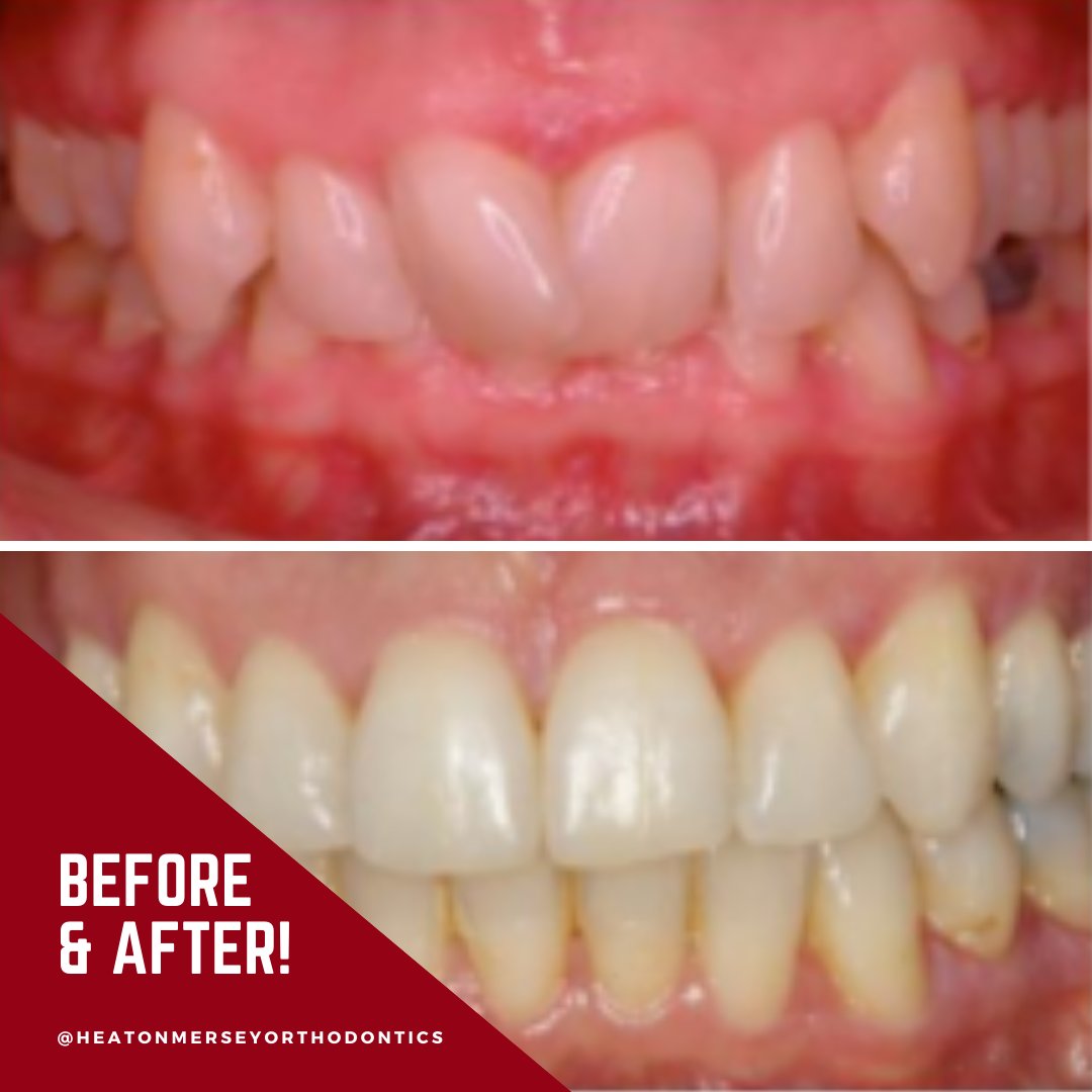 🤩 An amazing before and after from the Damon brace treatment.
This patient decided to have the treatment after seeing the results from her daughter’s treatment!
#DamonBraces #AdultOrthodontics
