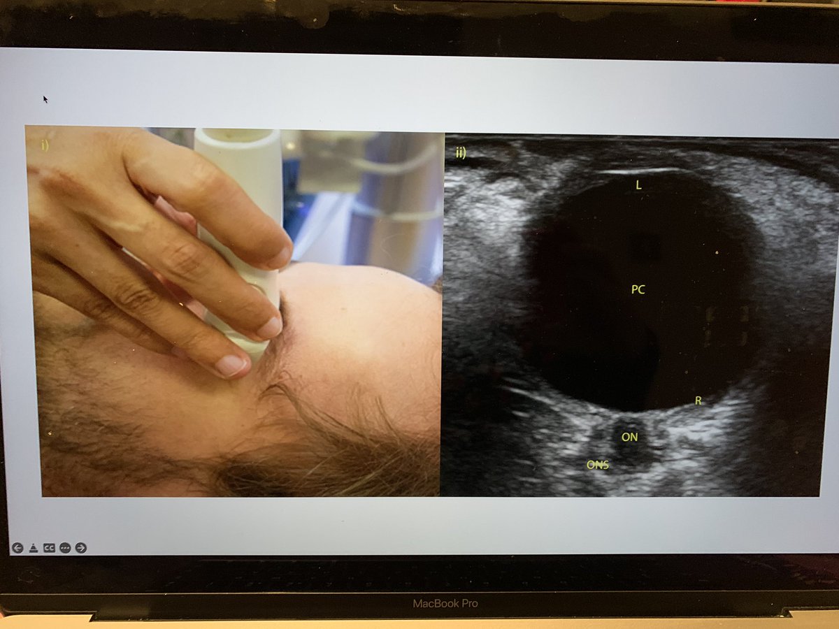 AcutemedSarbc's tweet image. Looking forward to our ultrasound course @GeneralistUS @SWBHnhs @chrisfduncan all about the use of POCUS for LP, papillodema , GCA and TCD and even more …@DanLasserson @twh_knight @FAMUSultrasound @ICS_updates @NHSmallwood @AIM_POCUS @AIMSpRs_WM