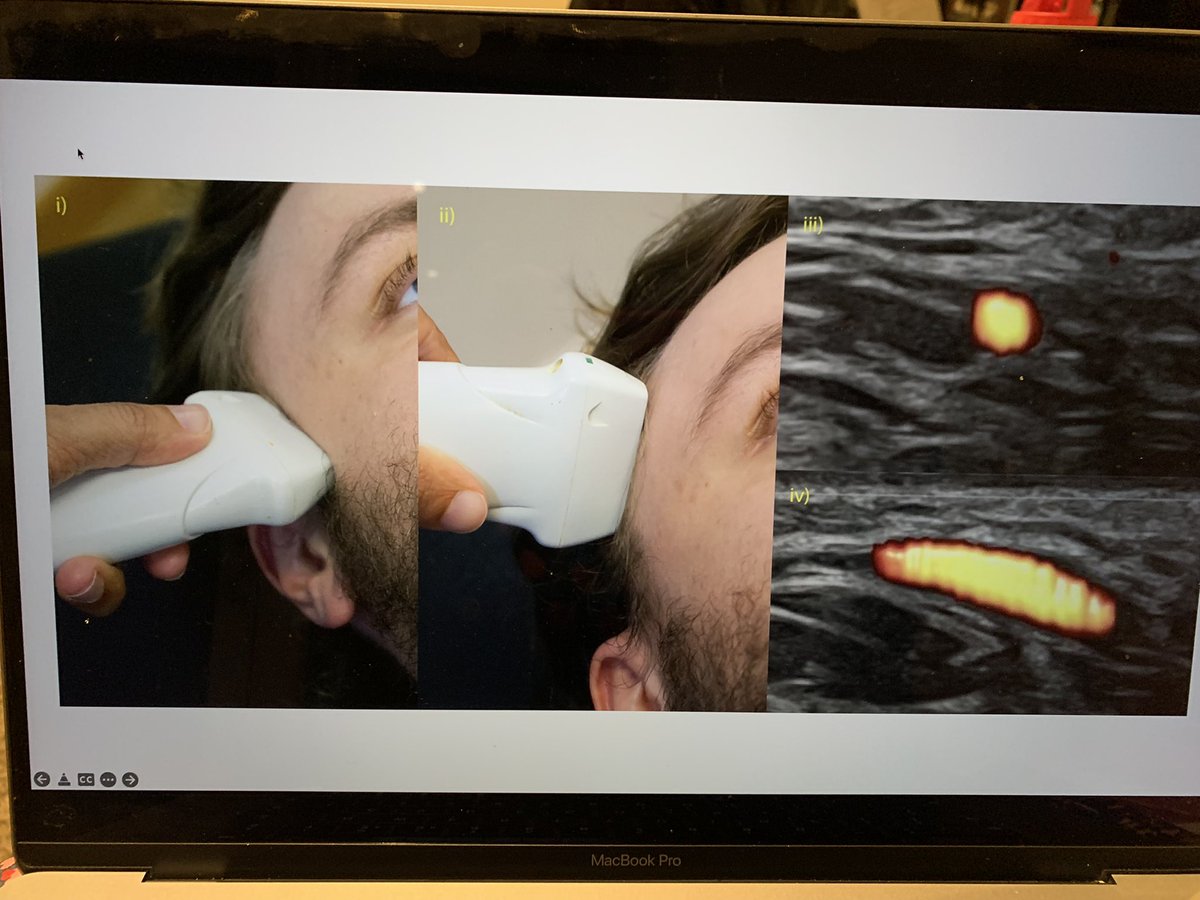 AcutemedSarbc's tweet image. Looking forward to our ultrasound course @GeneralistUS @SWBHnhs @chrisfduncan all about the use of POCUS for LP, papillodema , GCA and TCD and even more …@DanLasserson @twh_knight @FAMUSultrasound @ICS_updates @NHSmallwood @AIM_POCUS @AIMSpRs_WM