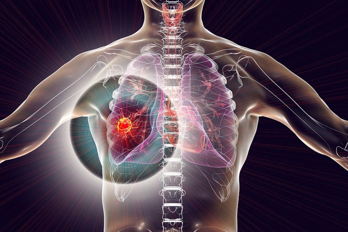 LungCancerEu's tweet photo. Doctors Must Stand at Frontlines in Fight Against Disparities in Screening, Treatment of Thoracic Malignancies: https://t.co/25lBsF5lMC
#LungCancer #Disparities #ManyFacesOneVoice https://t.co/9RGI4kgL8h
