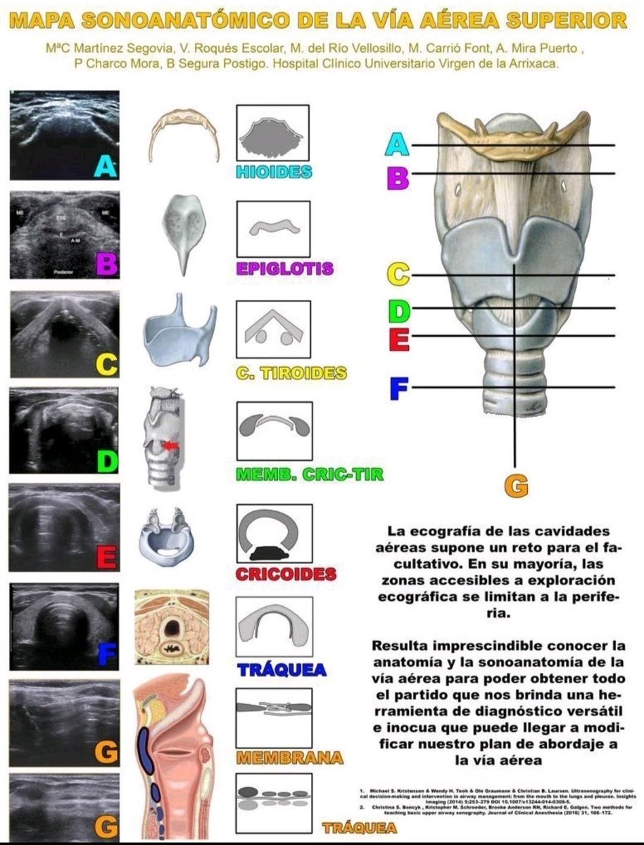 Gran trabajo de los compañeros del <a href="/SeRadArrixaca/">Servicio Radiología Arrixaca</a>

En la imagen podréis ver cómo son las estructuras y anatomía que debe ver un profesional de la #Radiología para rastrear la vía aérea superior por #Ecografía 

Los #TSID pueden aprender y realizar este mapeo perfectamente