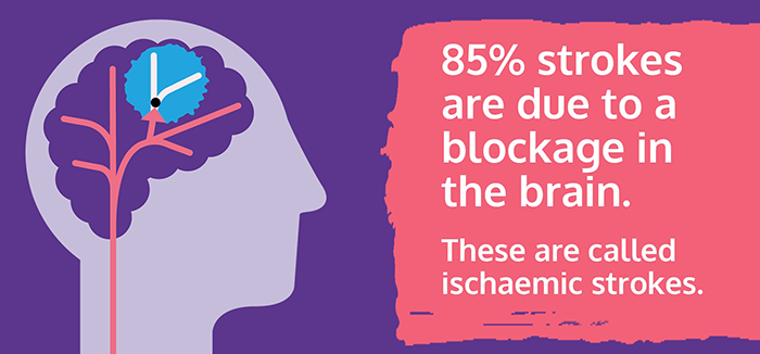TheStrokeAssoc's tweet photo. Ischaemic strokes are caused by a blood clot blocking an artery in the brain, depriving the brain of its blood supply. For as long as it remains in place, the clot causes brain tissue to die. In tonight's #Emmerdale Marlon received a thrombectomy, what's that you ask? Read on👇🧵 https://t.co/yyswZprsIV