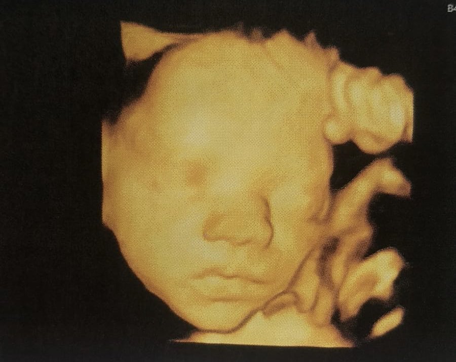 Ahora pretenden que los ginecólogos no llamemos bebé a esta preciosidad. Quieren que lo denominemos Fer, para no humanizarlo y hacer más fácil la decisión de abortarlo. Pues no señores, es un bebé y se ve bien claro
