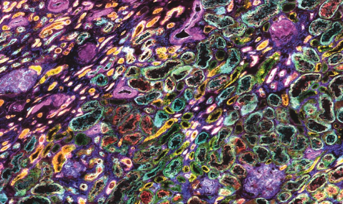 AkoyaBio's tweet image. PhenoCycler image of human kidney cortex. This image comes from a paper showing how a 23-plex #PhenoCycler experiment allows us to visualize the tissue architecture/microenvironment of the human kidney cortex. bit.ly/3sFNv1J

📷 @DrE_Neumann #kidneycancerawarenessmonth