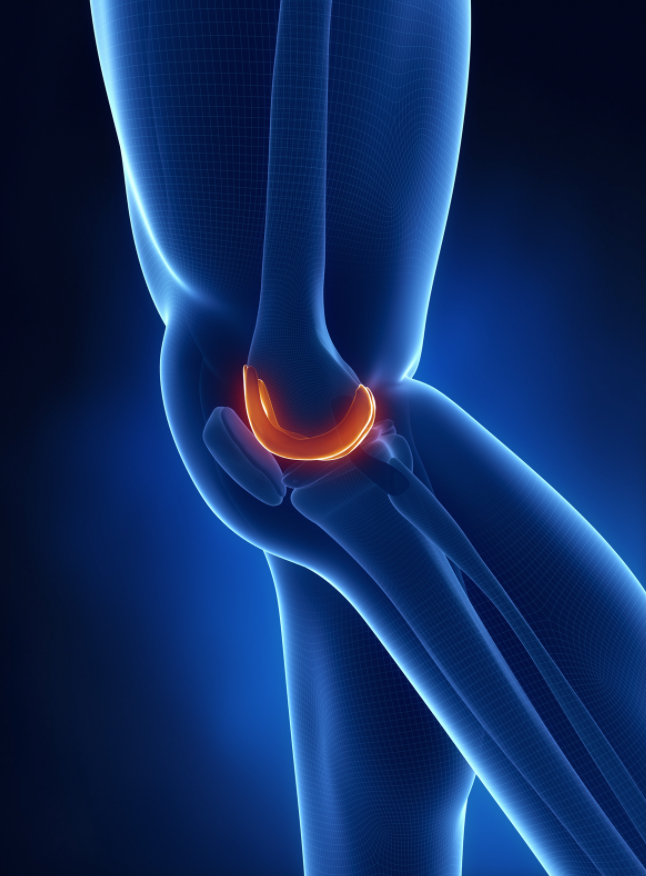 DrJeffPadalecki's tweet photo. When a patient presents damage to the #articula cartilage or an articular #cartilagedefect, it is of the utmost importance to treat this appropriately in an effort to restore the damaged area and preserve the surrounding cartilage. This treatment will... https://t.co/8Ctc2a1X5A https://t.co/NE3v9nYd5H