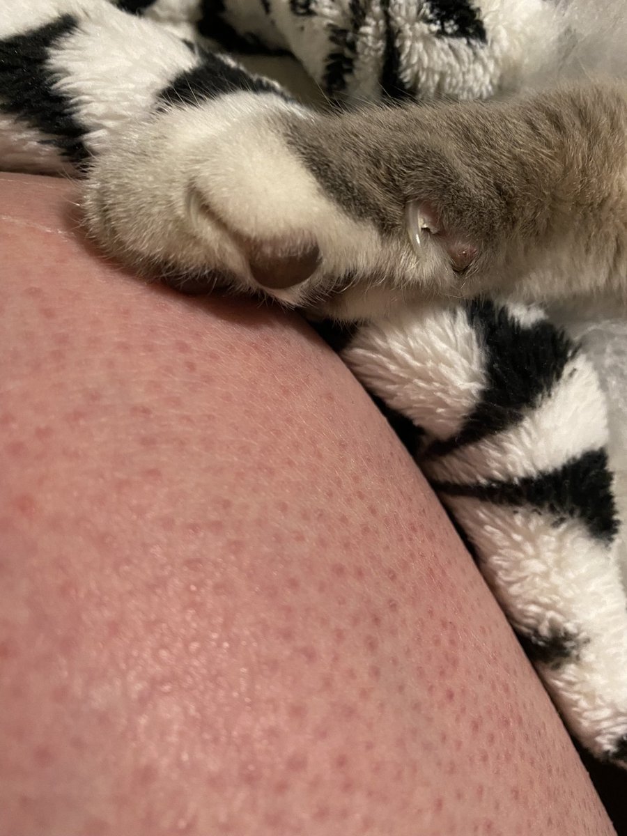 Sorry for my ugly leg but ❤️✨❤️✨❤️✨