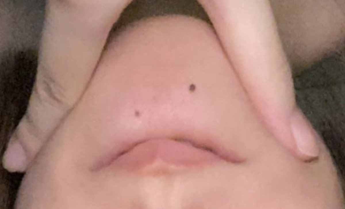 i have 2 moles in my chin and they kinda make a lil face :<