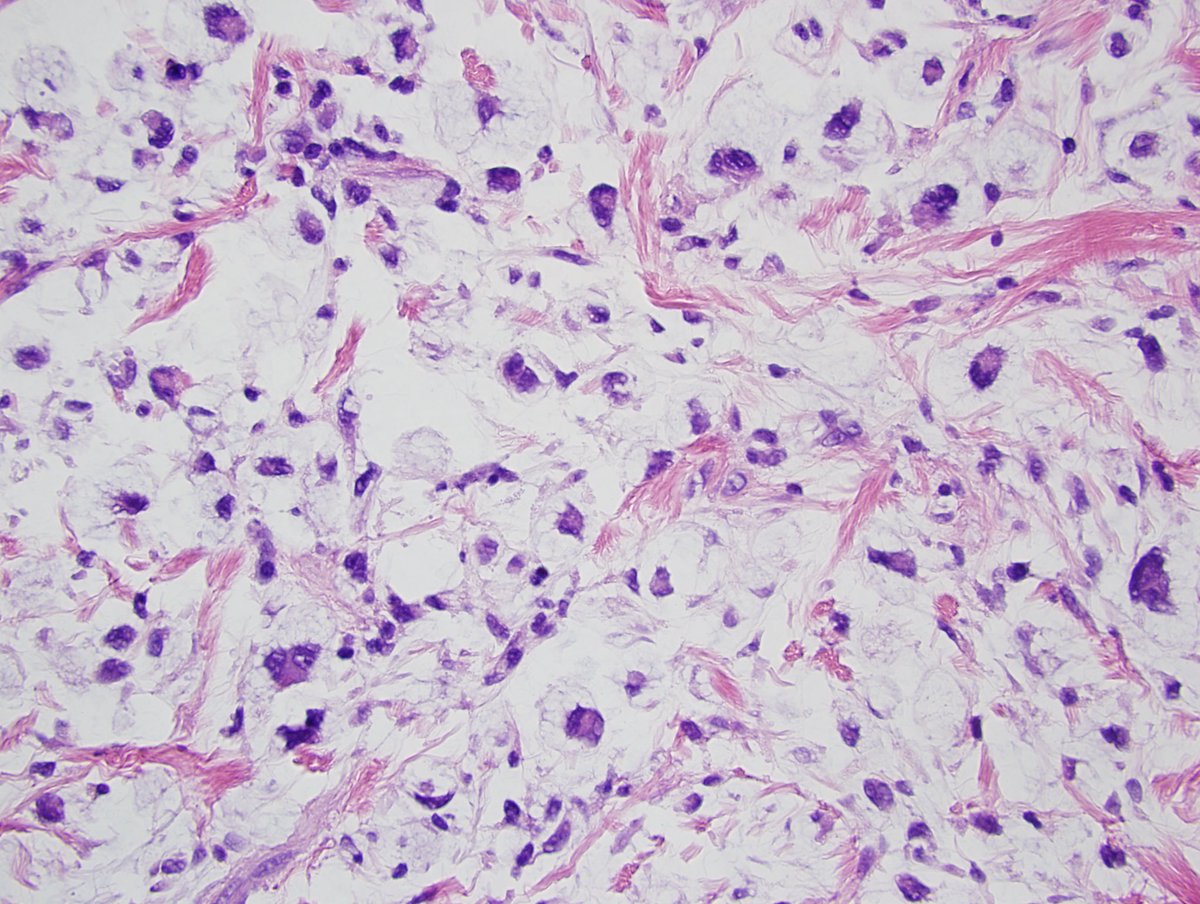 Williamson_SR's tweet photo. We have an unexpected opening for breast pathology fellowship at @CLEClinicLabs this year 22-23. Please reach out to me if any interest! #breastpath #USCAP2022 a picture of a myofibroblastoma with myxoid and epithelioid features for interest! https://t.co/mXmcSuwXGb
