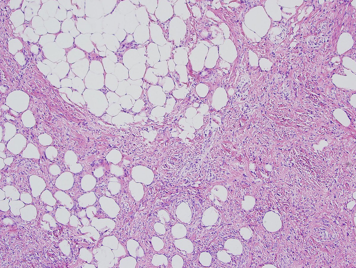 Williamson_SR's tweet photo. We have an unexpected opening for breast pathology fellowship at @CLEClinicLabs this year 22-23. Please reach out to me if any interest! #breastpath #USCAP2022 a picture of a myofibroblastoma with myxoid and epithelioid features for interest! https://t.co/mXmcSuwXGb