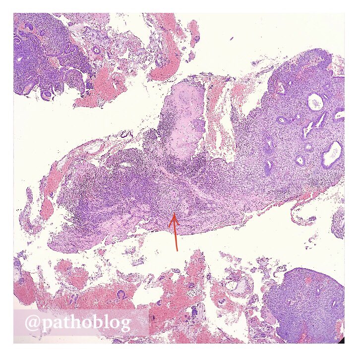 pathoblog's tweet photo. Endometrium... Granuloma... What's your theory, Sherlock? ๐ต๏ธโโ๏ธ
โ
#pathoblog #pathtwitter #pathology #gynpath https://t.co/CqxDbV9glP