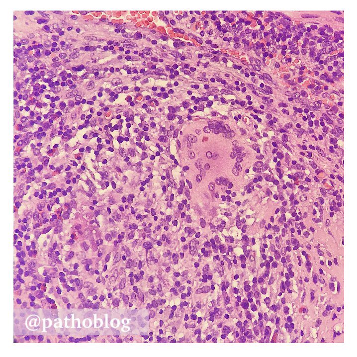 pathoblog's tweet photo. Endometrium... Granuloma... What's your theory, Sherlock? ๐ต๏ธโโ๏ธ
โ
#pathoblog #pathtwitter #pathology #gynpath https://t.co/CqxDbV9glP