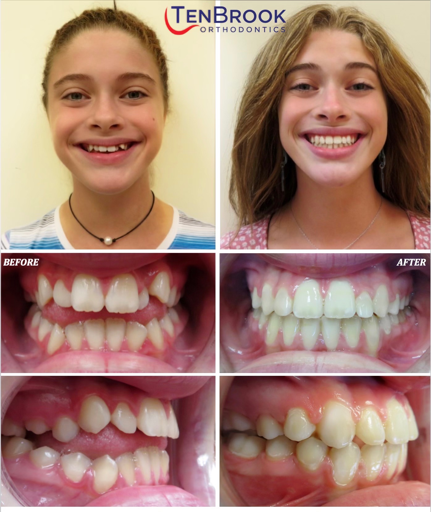 TenBrook Orthodontics on Twitter "M. came to us with Open Bite