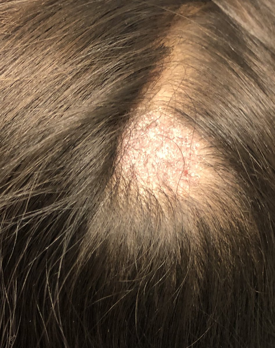 VVelascoT's tweet photo. 👧🏻 Placa eritematodescamativa en cuero cabelludo 
🔍 Escamas, pelos en coma, en zigzag, en código morse 
🔦 Fluorescencia con Luz de Wood 
🦠 Tinea capitis microspórica  (M.Canis) 
💊 Griseofulvina oral https://t.co/068Y9dvRwG