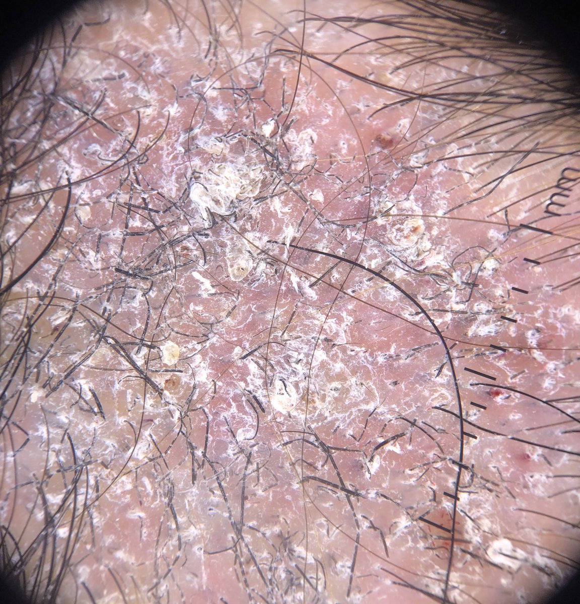 VVelascoT's tweet photo. 👧🏻 Placa eritematodescamativa en cuero cabelludo 
🔍 Escamas, pelos en coma, en zigzag, en código morse 
🔦 Fluorescencia con Luz de Wood 
🦠 Tinea capitis microspórica  (M.Canis) 
💊 Griseofulvina oral https://t.co/068Y9dvRwG