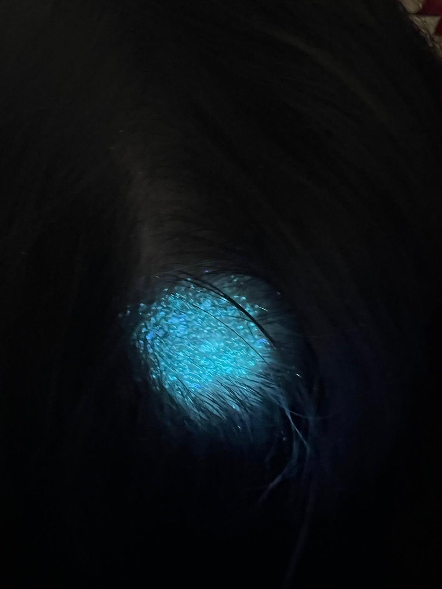 VVelascoT's tweet photo. 👧🏻 Placa eritematodescamativa en cuero cabelludo 
🔍 Escamas, pelos en coma, en zigzag, en código morse 
🔦 Fluorescencia con Luz de Wood 
🦠 Tinea capitis microspórica  (M.Canis) 
💊 Griseofulvina oral https://t.co/068Y9dvRwG