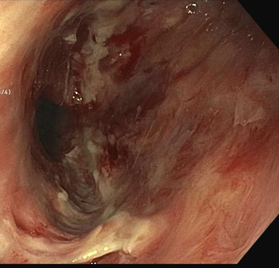 acbaxi's tweet photo. #GITwitter Need some help:
Pt w/ hx of lymphoma complicated by esophageal pleural fistula (and bronchopleural fistula) w/ persistent large cavity/fistula despite multiple therapies most recently w/ nearly 2 months of endoscopic vacuum therapy w/ only marginal improvement. https://t.co/bK7DvKdiic