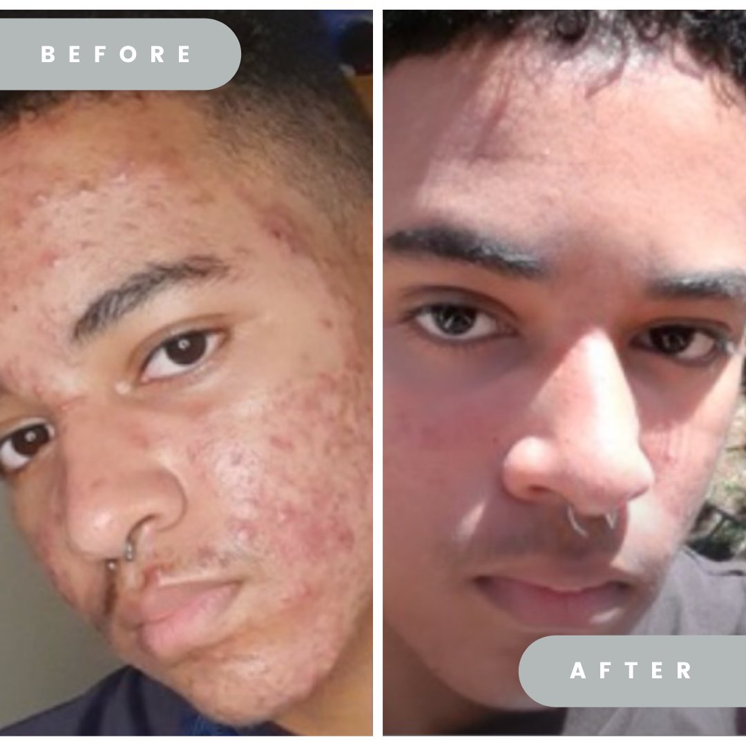 SkinFunctional's tweet photo. WOW! We absolutely love sharing in your skincare journey - it fills our hearts!π
Remember to tag us in your journey by using #TheSkinFunctionalEffect so we can all take into for each other. π€
#skinfunctional #skincarebusiness #skincarejourney #beforeandafter #skincareza https://t.co/0cMnGOsLGD