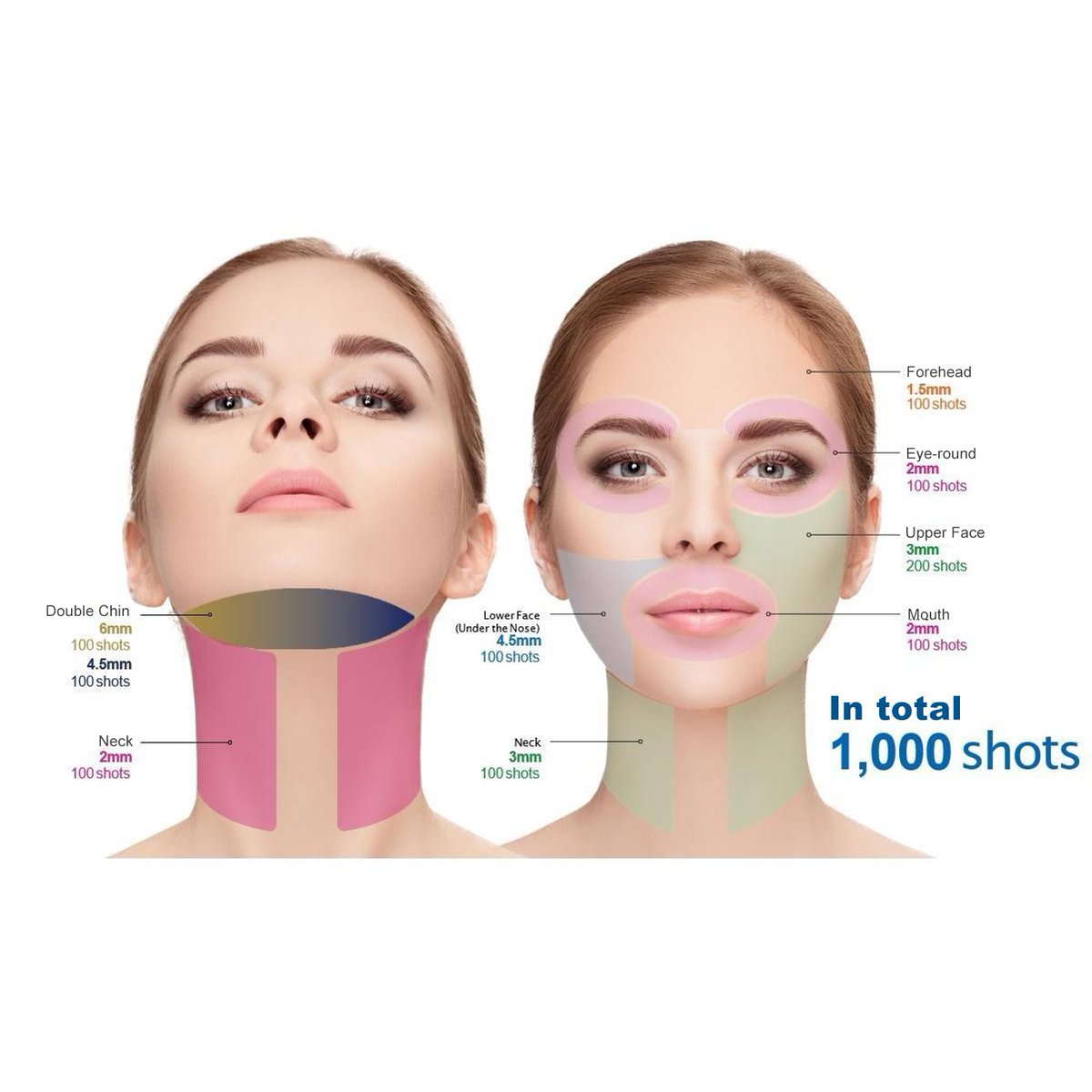 EVALASERTECH's tweet image. 7D HIFU💯
✅Non-Invasive Procedure
✅Natural&amp;amp;Gradual Results
✅15-20 mins Procedure Time
✅No Downtime 
✅No Anesthesia 
✅No Pre Preparation Required
✅No Post Treatment Requirements
✅Minimal Adverse Events
✅Minimal Requirements to Receive Treatment
#hifu #hifufacial #7dhifu