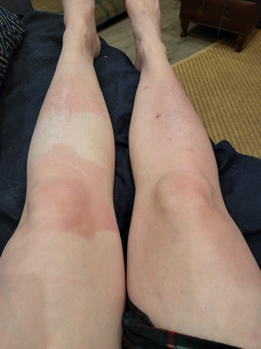 LFlett31's tweet photo. @HP_Community Perils of enjoying the sun wearing a knee splint.....whoops!!! 🤣 
Was lovely to work on my laptop in the garden...have a good week all. https://t.co/Yy9JhDqOgj