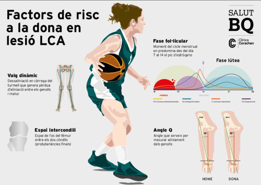 doctoratrevi's tweet photo. Porqué las mujeres tenemos más riesgo de sufrir lesiones del LCA?

El baloncesto junto al fútbol,rugby, tenis,esquí,voley y gimnasia son los deportes con mayor riesgo por los movimientos que implican:
-salto con apoyo de un pie
-frenadas y desaceleraciones
-cambios de dirección https://t.co/oi79sf52jB