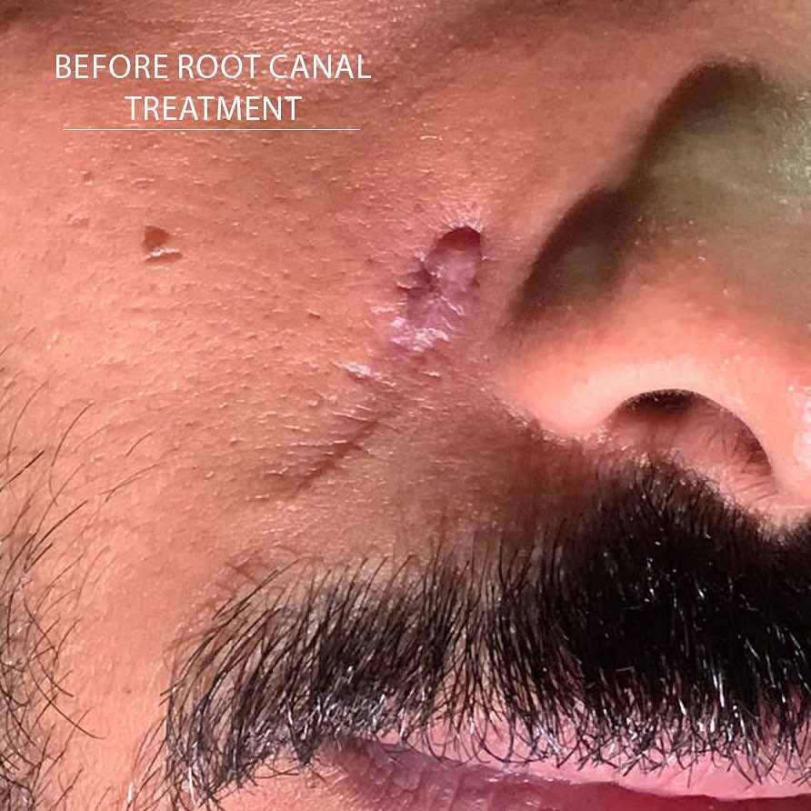 den_saud's tweet photo. History of misdiagnosis !!
Patient had suffered with recurrent facial fistula over one year.
He presented to my clinic with CC: recurrent fistula and abscess. 
He did surgical removal by dermatology two times in the past which had failed . https://t.co/br2urR05je