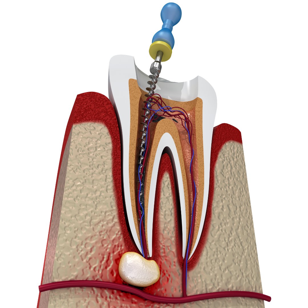 If you are told that a tooth requires a root canal procedure, there’s no need for alarm. Today, a root canal procedure is as routine and comfortable as receiving a dental filling.