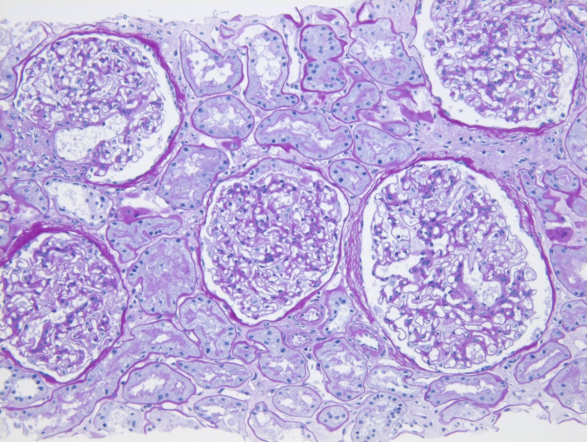 ChangUCanSpare's tweet photo. The extent of interstitial fibrosis/tubular atrophy appears mild, but 5 glomeruli should never be this close to each other and suggests significant tubular loss that would be underestimated by IF/TA alone. #renalpath https://t.co/70rOvK9N5z