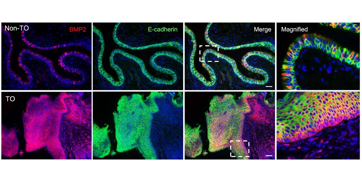 ExtracellMatrix's tweet photo. Malfunction of airway #BasalStemCells plays a crucial role in the pathophysiology of tracheobronchopathia osteoplastica 🫁 by acting as a repository of inflammatory and #TGFβ-BMP signals, according to recent research in @NatureComms.
#OpenAccess: 🔓 https://t.co/kwIhmjgSse https://t.co/6CYO8yPryZ