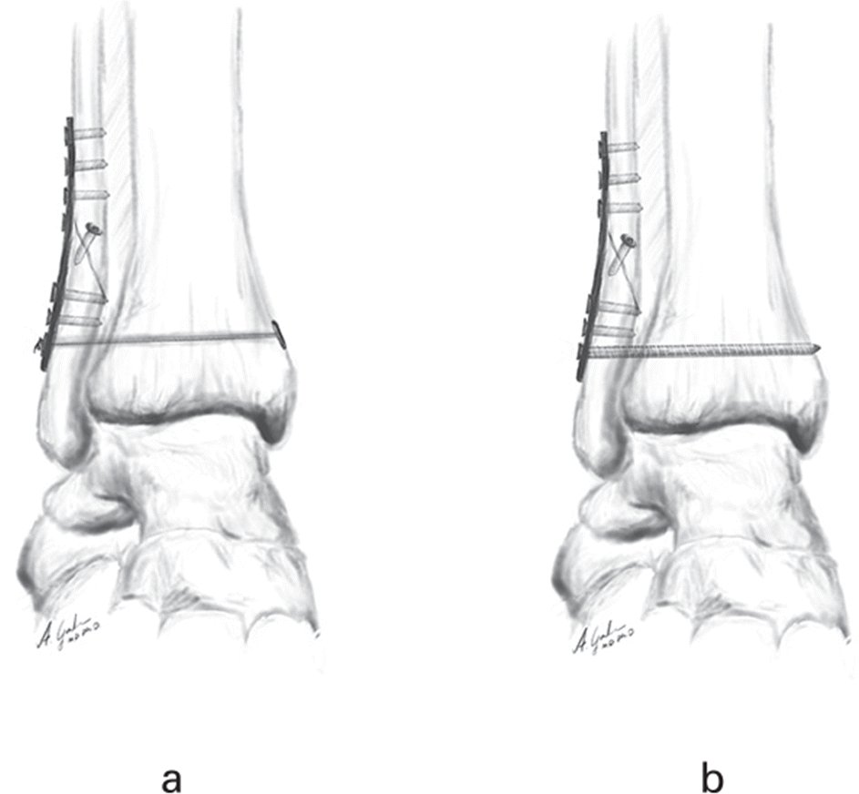 Illustration of syndesmotic fixation with a suture button and syndesmotic fixation with a quadricortical screw.