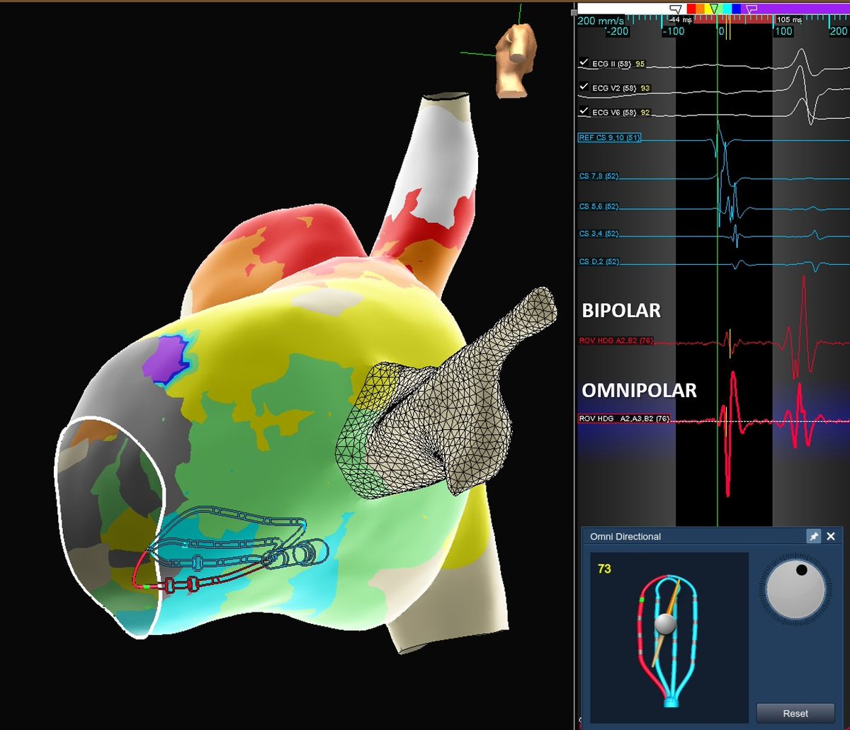 How much emphasis is put on the A:V ratio when ablating AVNRT? SP site w/ 'ideal A:V' on A2B2. Wavefront-corrected OT EGM would typically be seen as too large of an A. Has an error in directional sensitivity been assumed as physiology? #OmnipolarTechnology challenges convention.