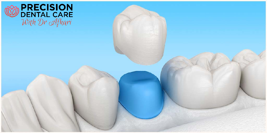DrAfkari's tweet image. Consider dental caps to strengthen &amp;amp; reinforce your teeth. 👨‍⚕️👩‍⚕️🦷 #DentalCaps #TeethCaps #Caps #DentalTreatment #DentalHealth