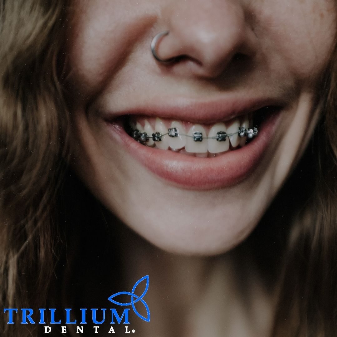 Did you know that there are different types of braces? If you have any questions regarding your teeth health journey, drop by your local Trillium Dental. We’re here to help!

#canada #dentist #oralhealthcare