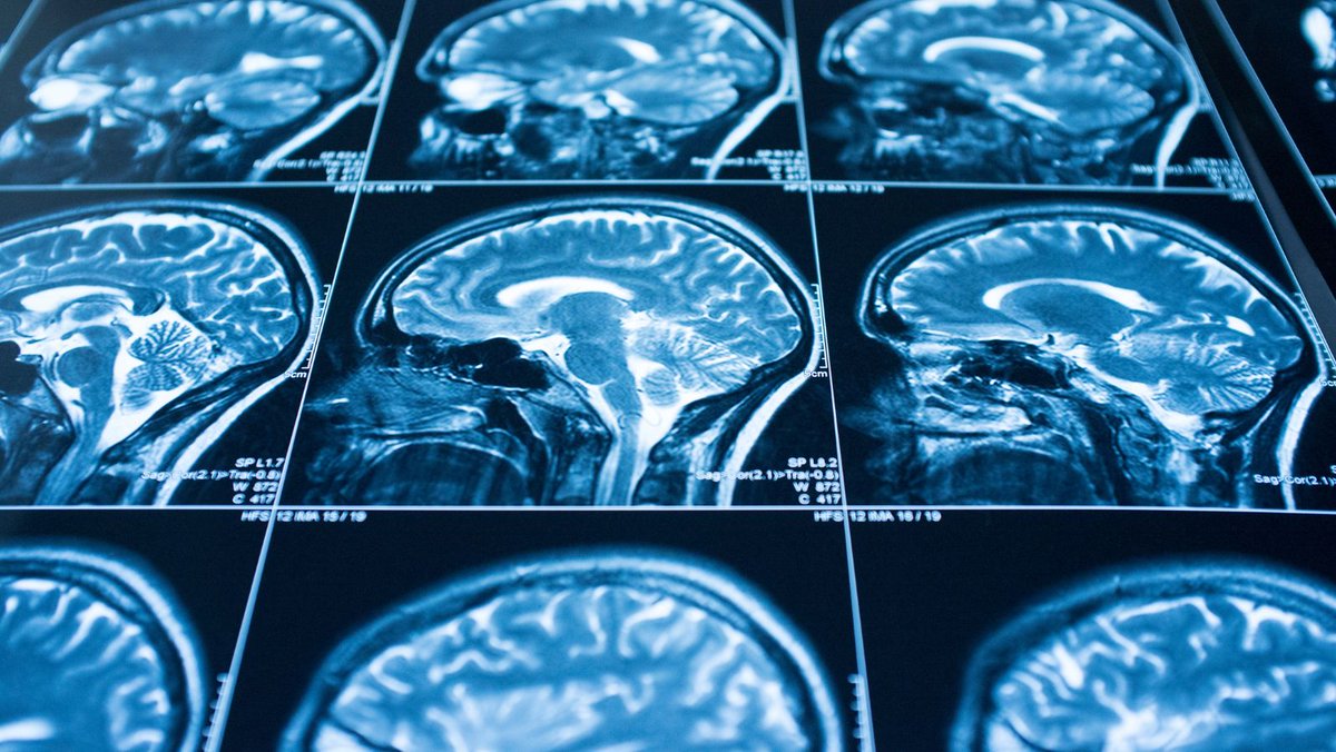 ECTRIMS's tweet photo. #MSJournal: In the phase III #ASCLEPIOS I and II trials, participants with relapsing #MS receiving #Ofatumumab had significantly better clinical and #MRI outcomes than those receiving #Teriflunomide 👉 https://t.co/x9ZGk0M5QV https://t.co/hsI3Zfesgs