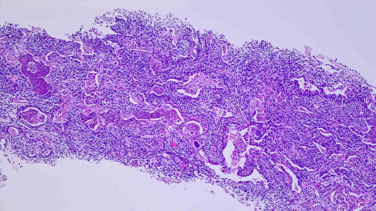 JDCo2pock's tweet photo. 36F, foot mass, bx. Malignant-appearing glands with luminal necrosis, expressing AE1/AE3 and GATA3, with accompanying stroma unusual for adenocarcinoma. TLE1 expression diffuse in glands and stroma. SS18 rearranged by FISH. Biphasic synovial sarcoma. #PennPath #BSTpath https://t.co/FRilXbw6HJ